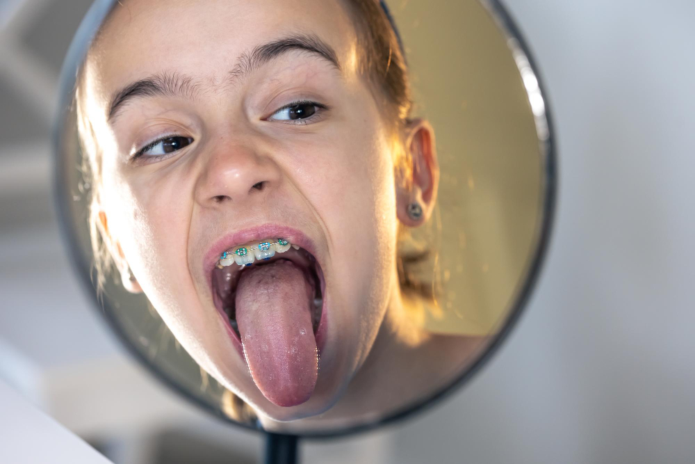 Correcting Tongue Thrust